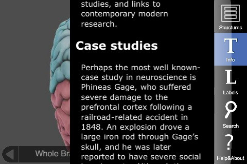The 3D Brain app showing the well-known case study of Phineas Gage